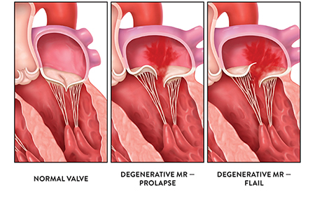 Mitral valve examples
