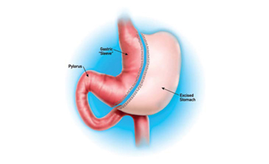 Gastric resection illustration