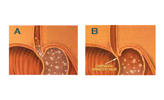 illustrations of esophageal valve
