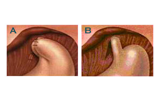 Illustrations of after and before antireflux surgery