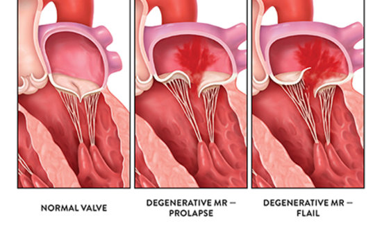 Mitral valve examples