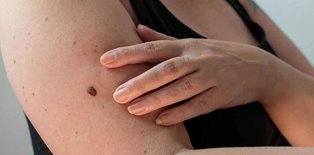 Women with skin lesion on arm